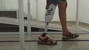 o que é amputação transtibial