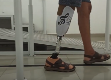 o que é amputação transtibial