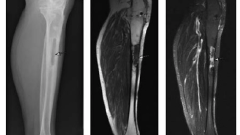 O Que é Osteomielite? Sinais, Sintomas E Tratamento